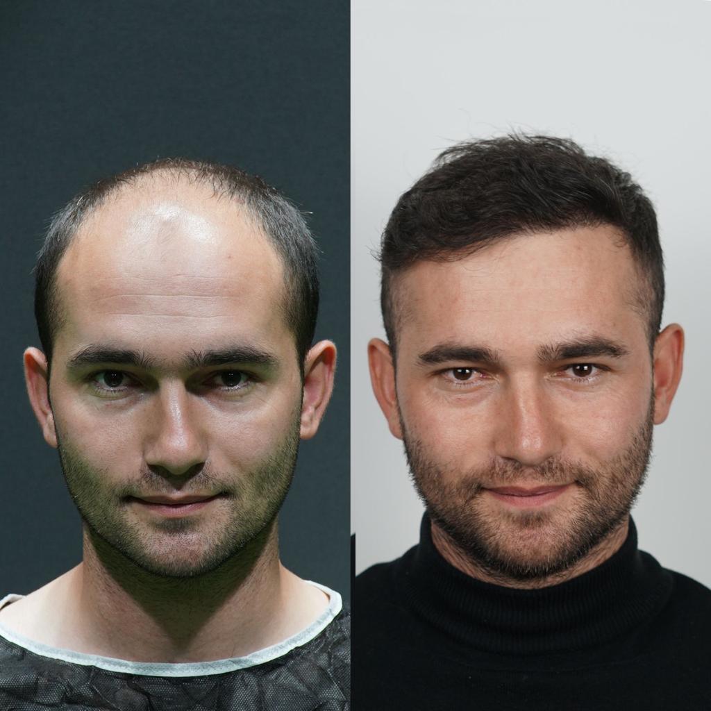 prima e dopo trapianto capelli